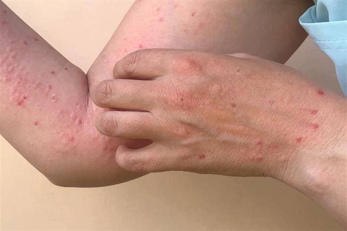 الصحة العالمية توافق على أول اختبار تشخيصي لمرض جدري القردة