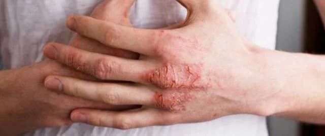 باحثون يحددون الفئة الأكثر عرضة للإصابة بالأكزيما